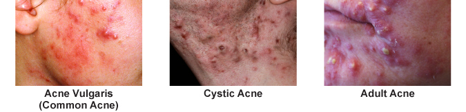 Types of acne we treat in and around central florida Image of different types of acne we treat in orlando